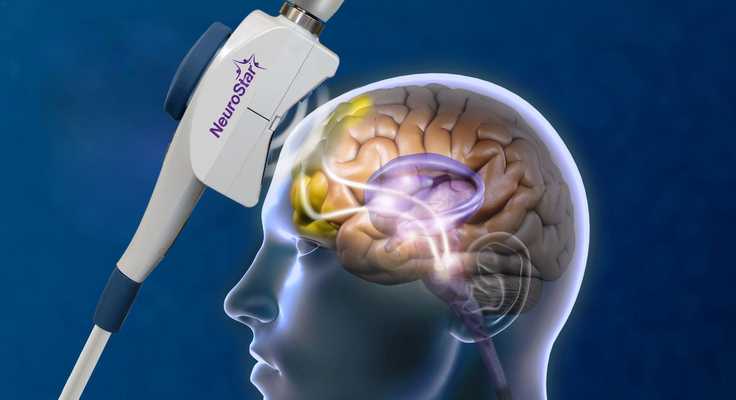 Looking for NeuroStar TMS treatment near Fort Lauderdale? Learn what NeuroStar is, how long treatment takes, and how to get started locally.
